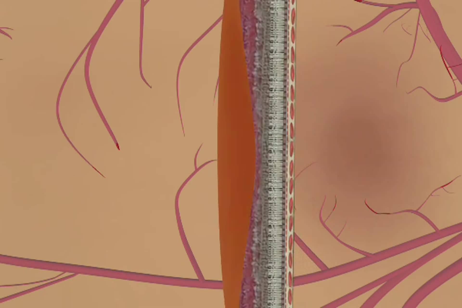 Macular Degeneration - What is dry macular degeneration?