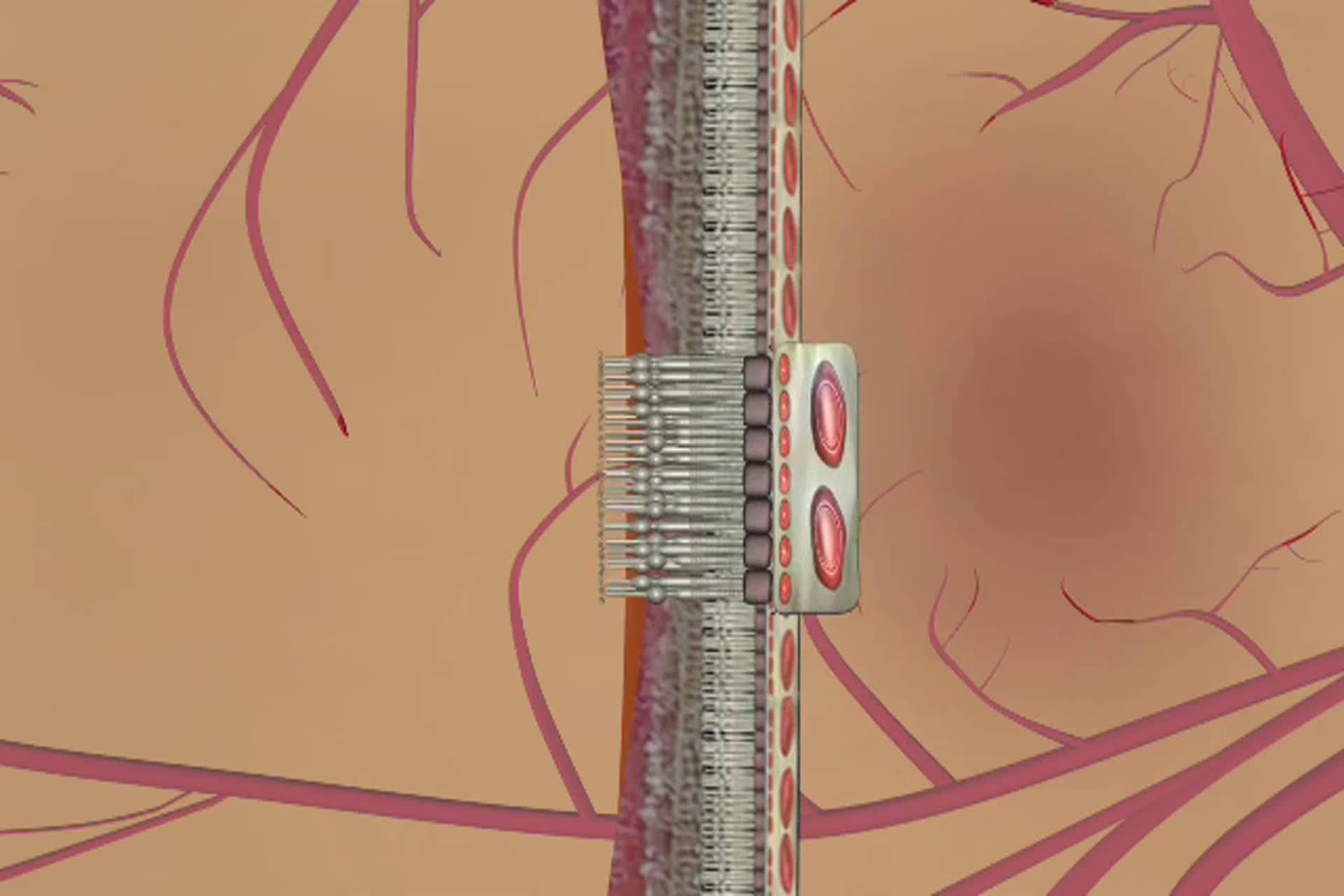 Macular Degeneration - What is wet macular degeneration?