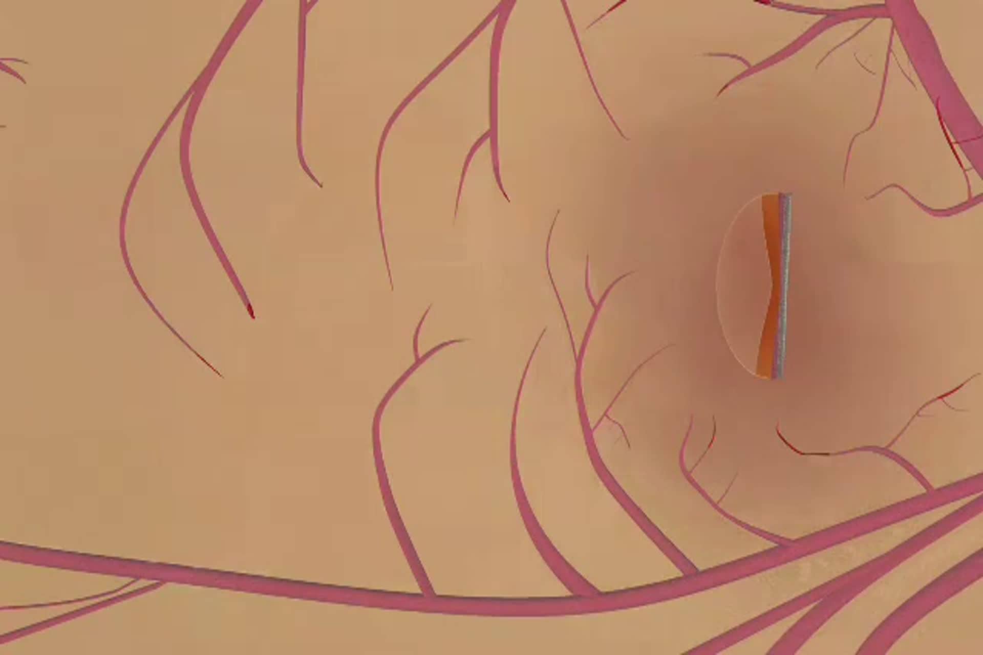 Diabetes - What is Non-Proliferative Diabetic Retinopathy (NPDR)?