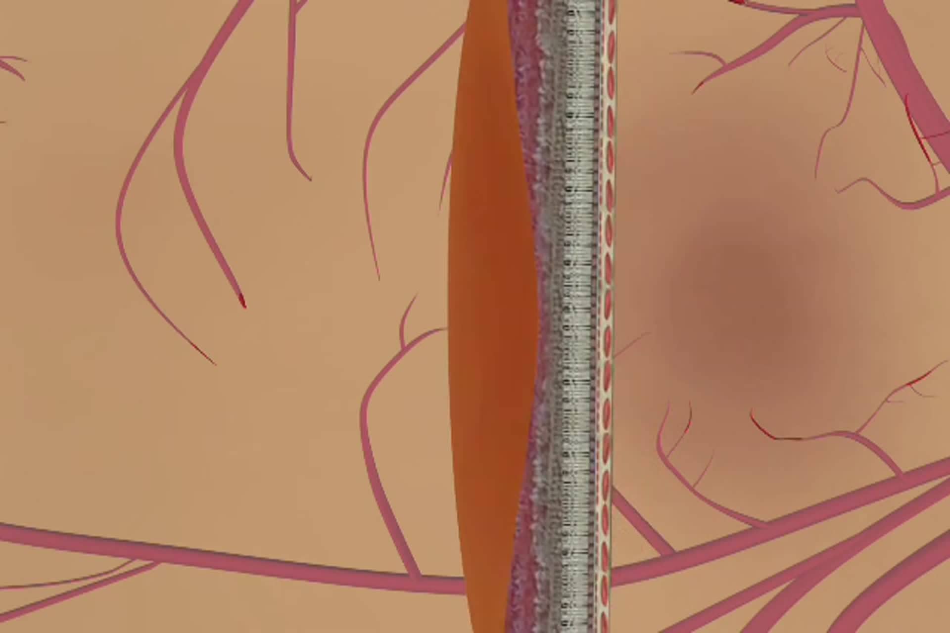 Degeneración macular - ¿Qué es la degeneración macular seca?