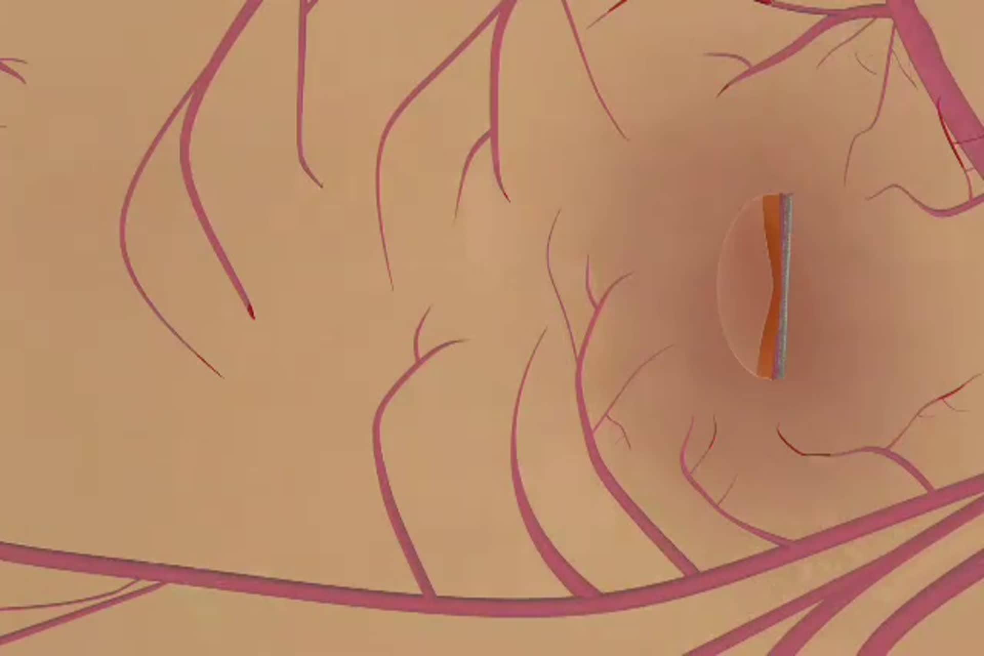 Diabetes - ¿Qué es la retinopatía diabética no proliferativa (RDNP)?