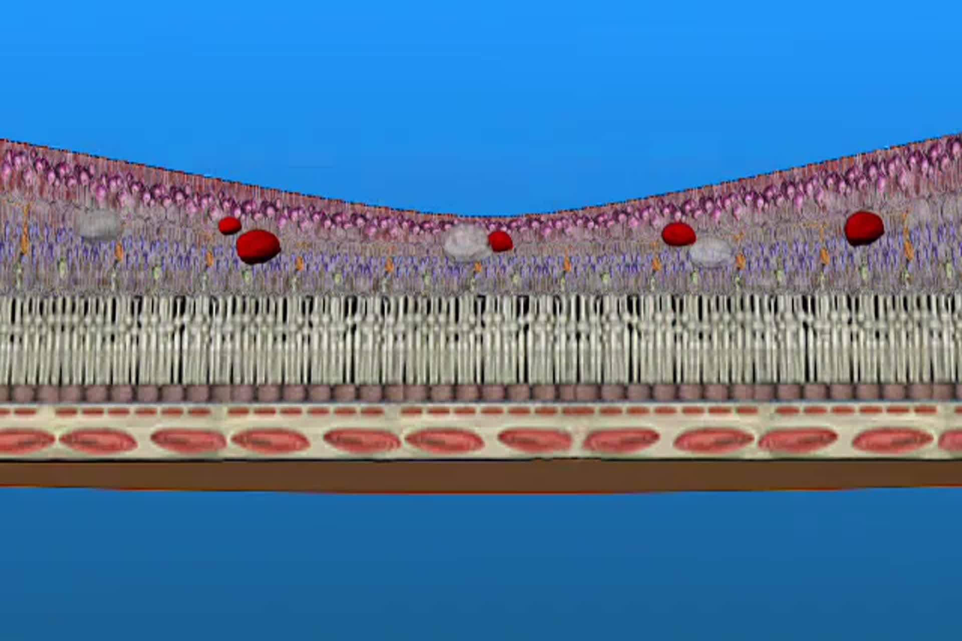 Diabetes - ¿Cuál es la isquemia o edema macular?