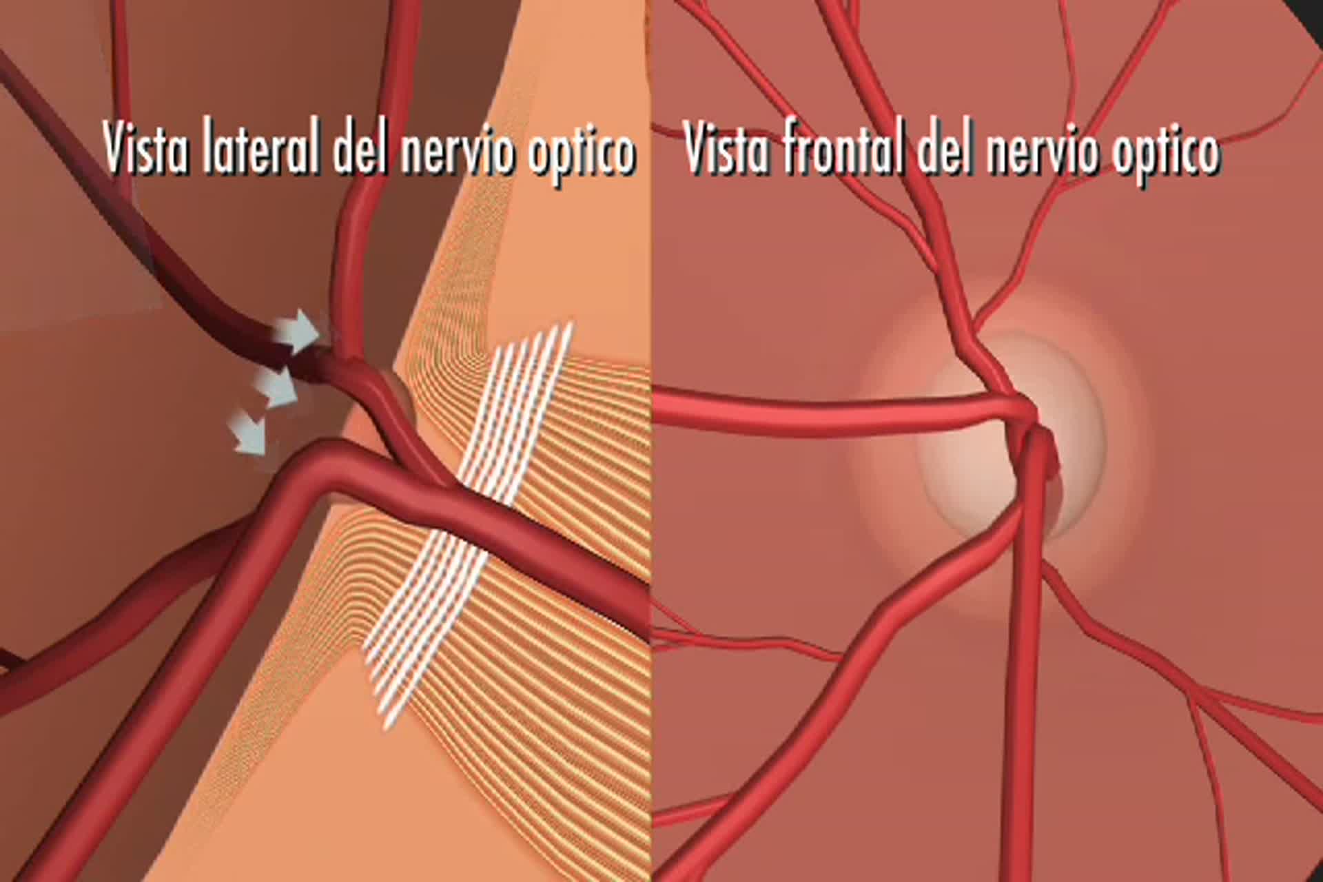 Glaucoma - ¿Qué es la excavación del nervio óptico debido a la pérdida de fibras nerviosas?