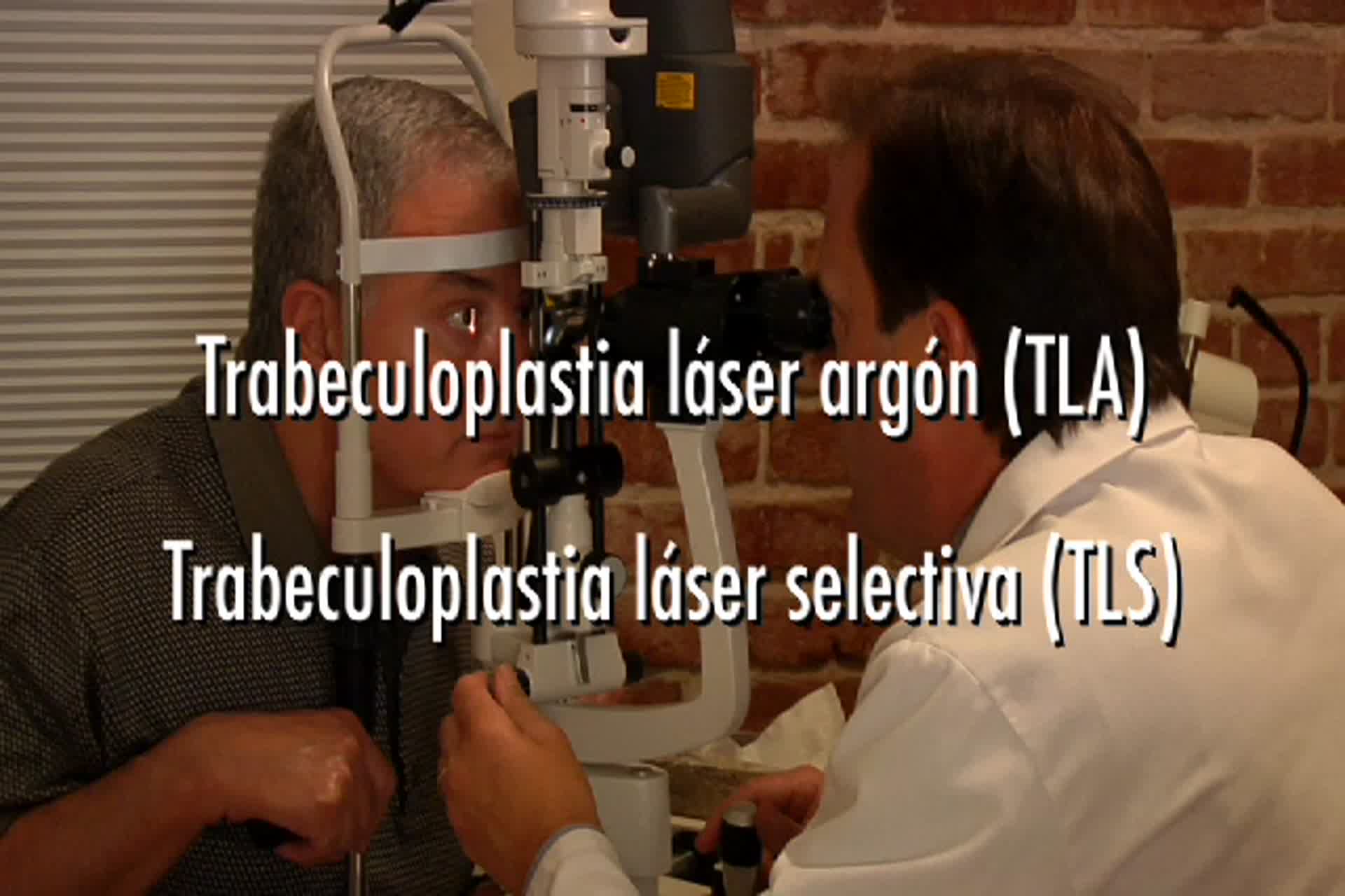 Glaucoma - ¿Qué es la cirugía con láser para el tratamiento del glaucoma?