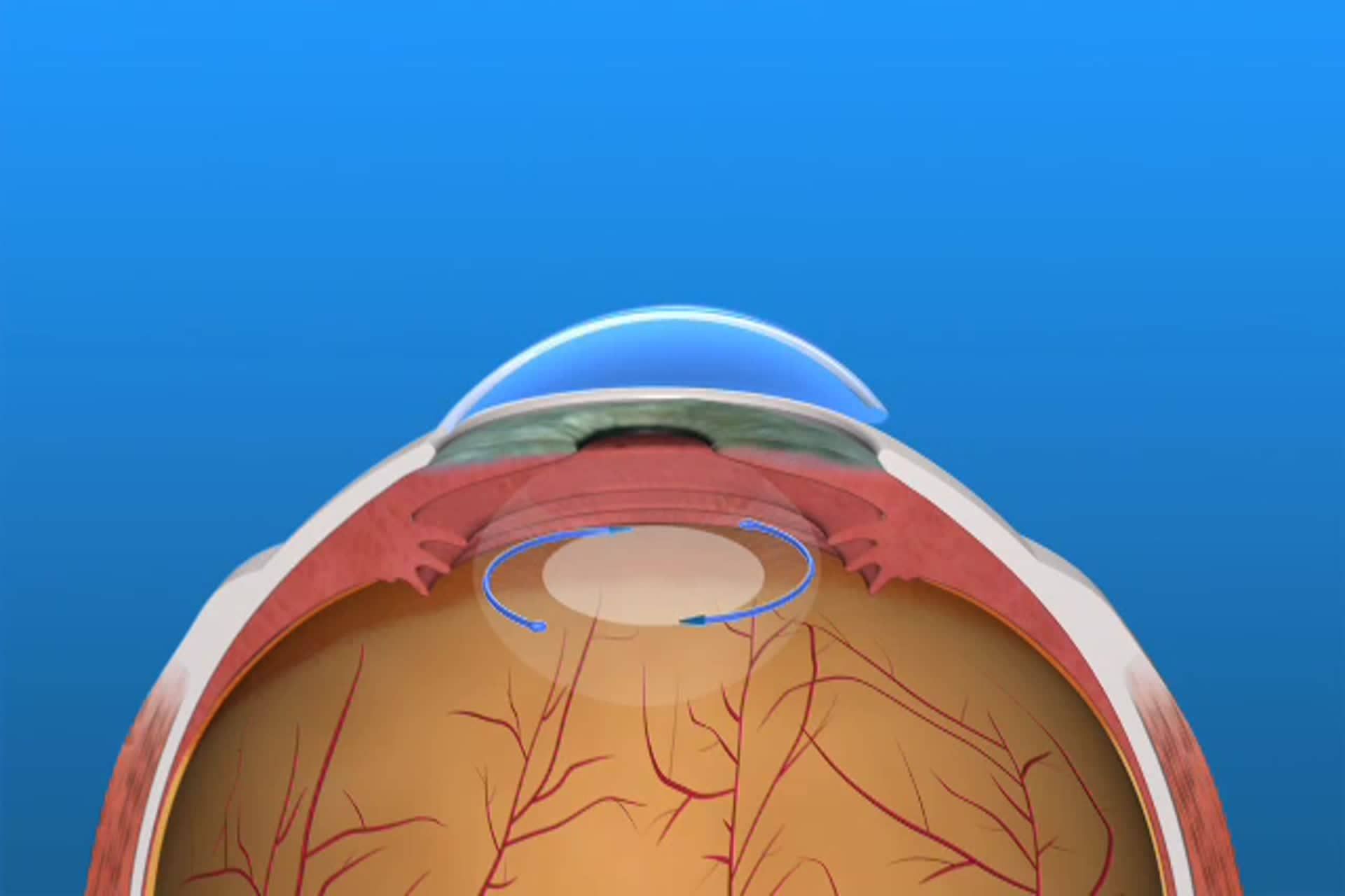Lente intraocular para el astigmatismo Lente intraocular para el astigmatismo