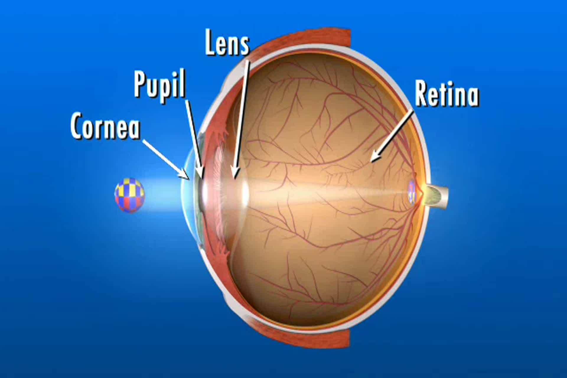 Cataract - How do my eyes see?