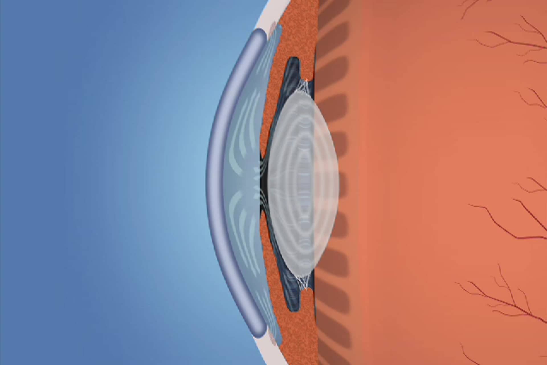 Glaucoma - What is open-angle glaucoma?