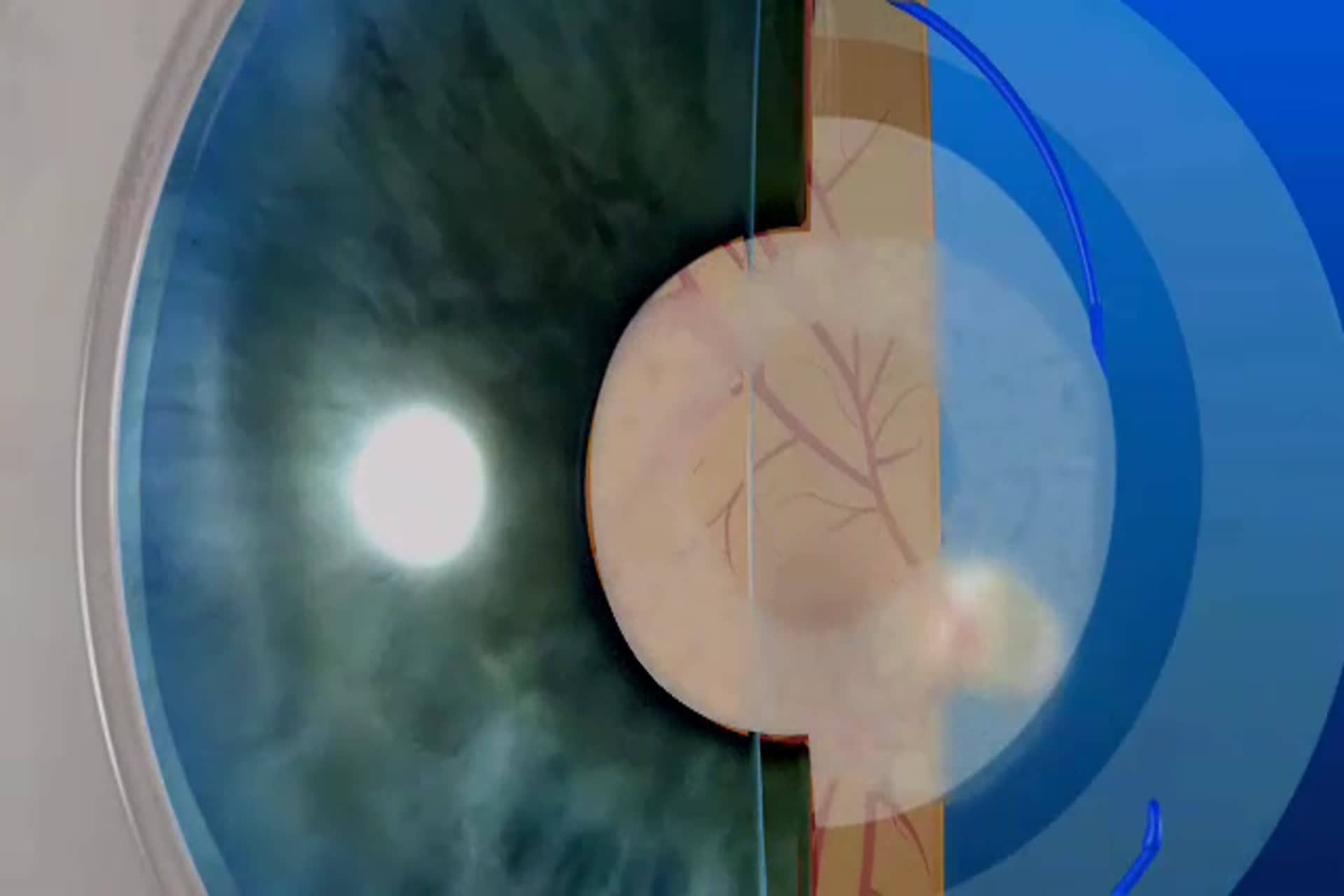 Cataract - What is laser surgery for secondary cataract?