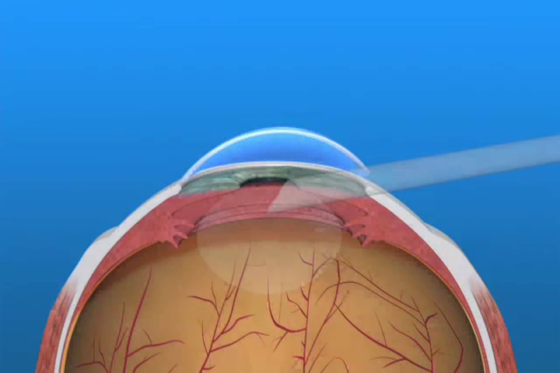 Catarata - ¿Qué es una lente intraocular tórica para la corrección del astigmatismo?