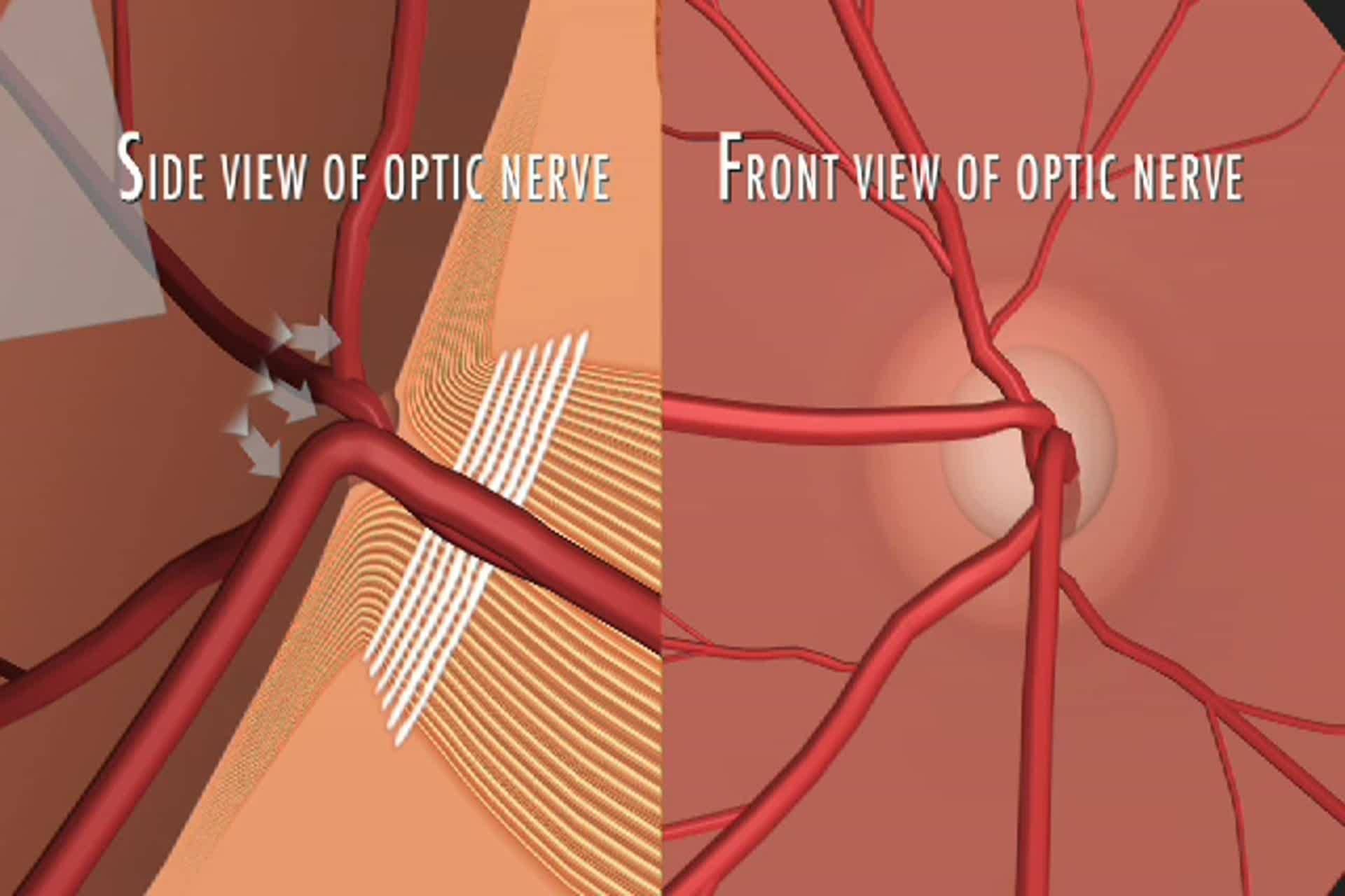 Glaucoma - What is optic nerve cupping from loss of nerve fibers?