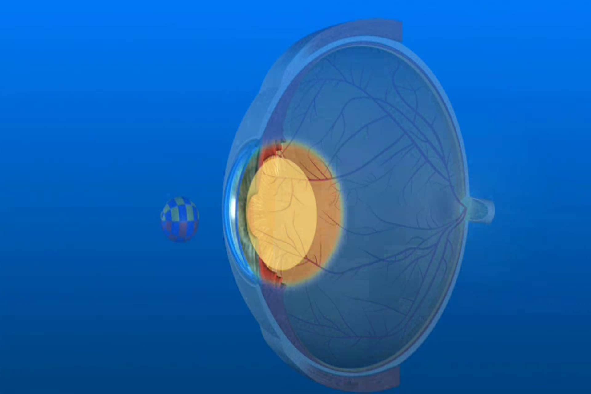 Cataract - How are my eyes affected by cataract?