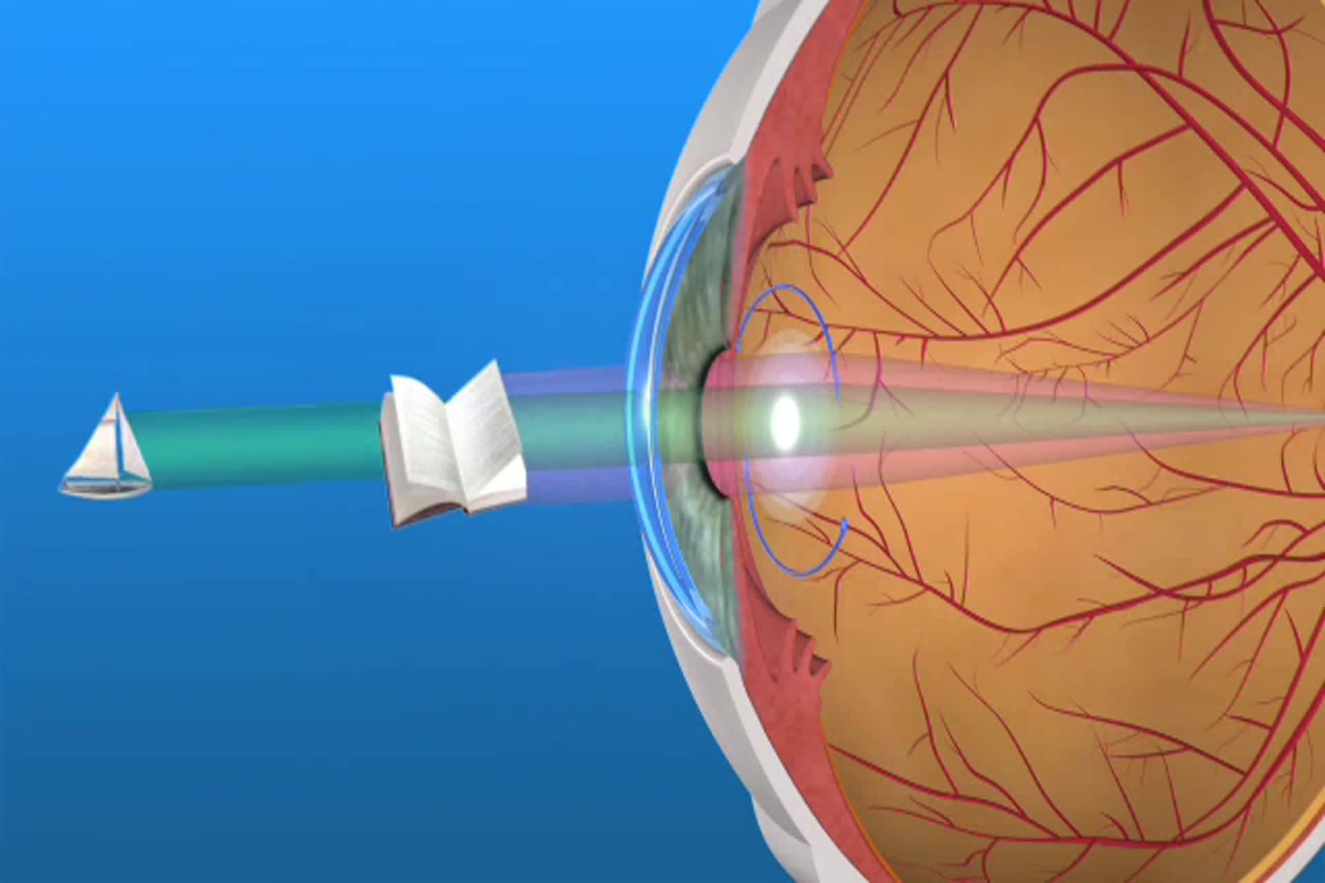 Cataract - What is a multifocal lens used in cataract surgery?