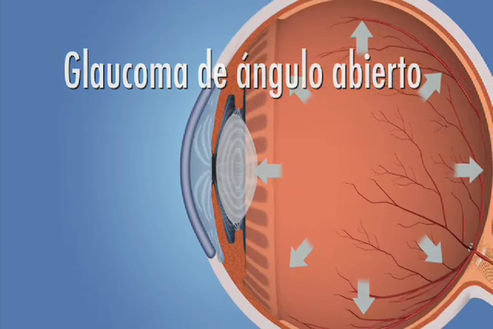 Glaucoma - ¿Qué es el glaucoma de ángulo abierto?