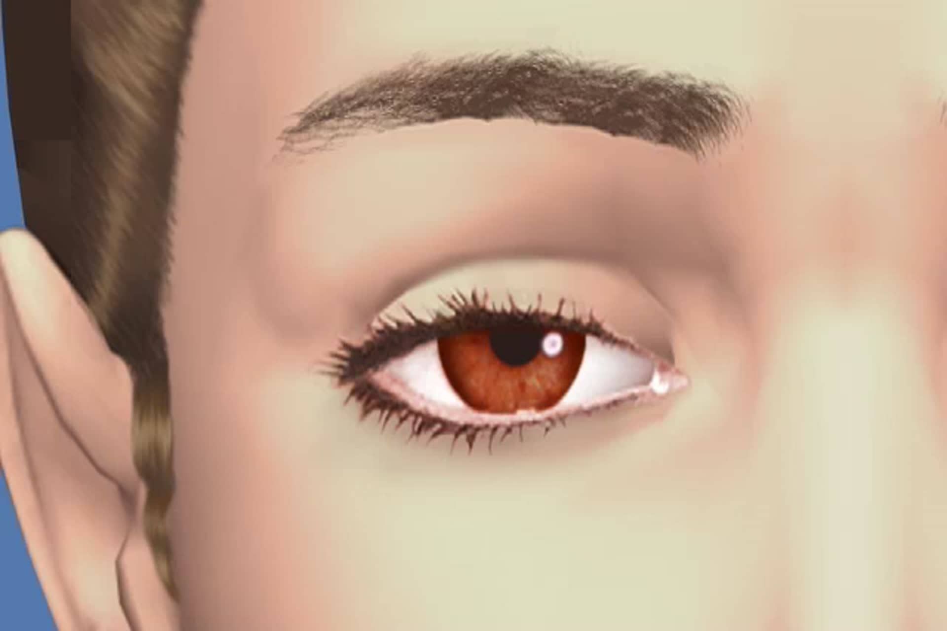 Eyelid - What are droopy eyelids or blepharoptosis?