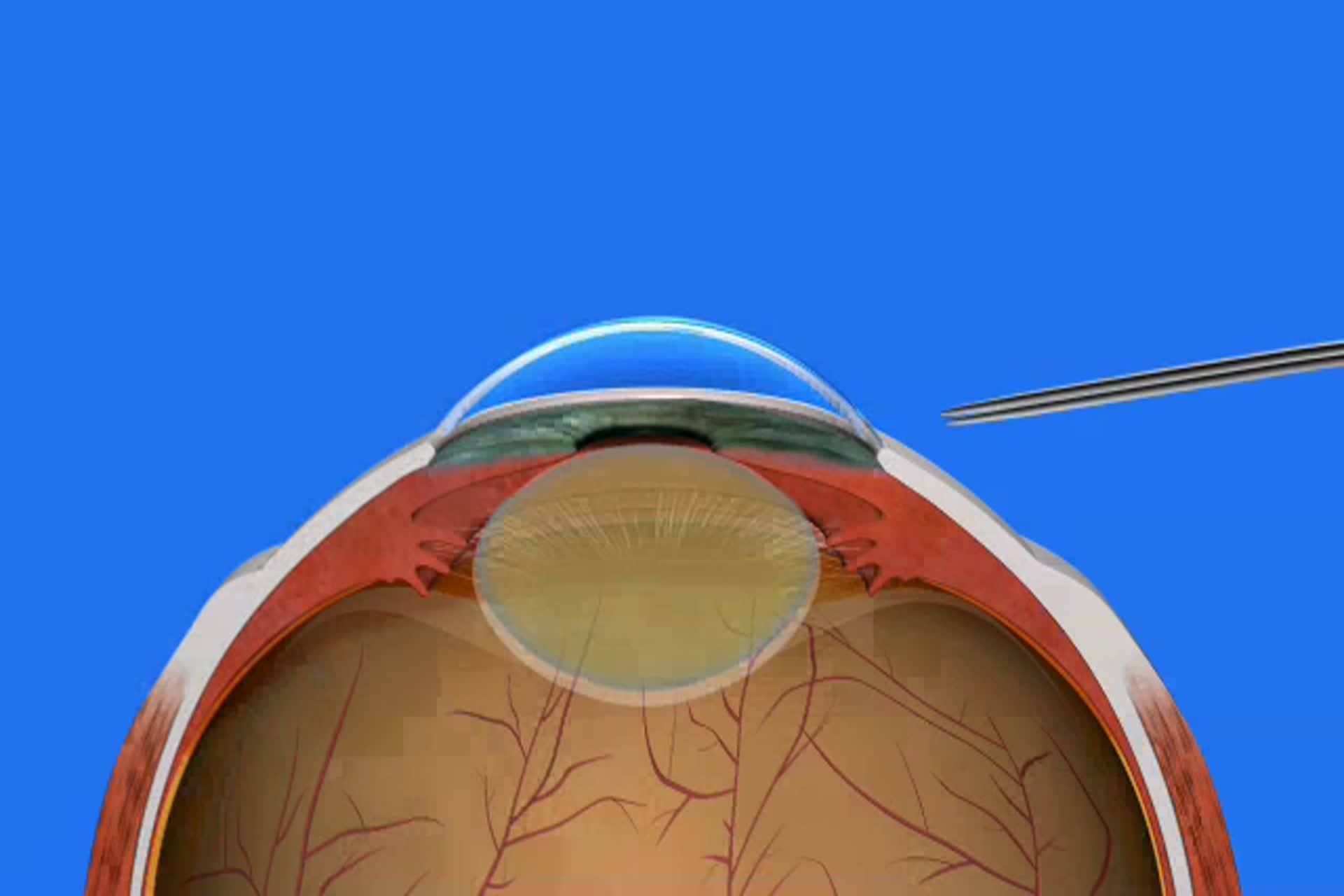 Cataract - What is cataract surgery?